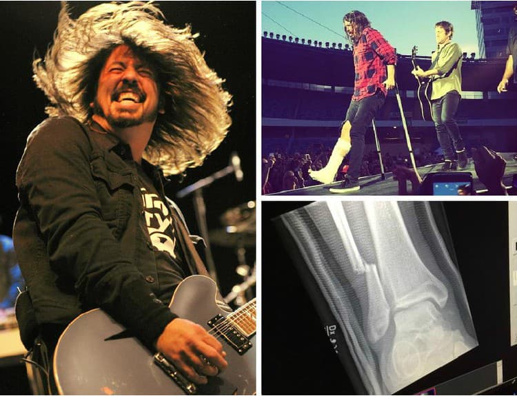 Dave Grohl je najväčší pán: Na koncerte si zlomil nohu, dohral ho o barlách