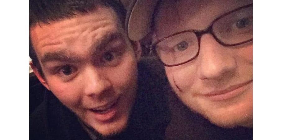 Ed Sheeran (vpravo) s poraneným lícom, 2016